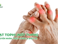 Hạt Tophi (Nốt Tophi): Nguyên Nhân, Triệu Chứng & Điều Trị