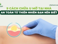 9 Cách Chữa U Mỡ Tại Nhà An Toàn Từ Thiên Nhiên Bạn Nên Biết