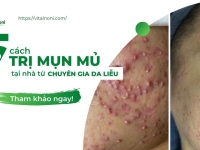 Mách bạn 5 cách Trị Mụn Mủ tại nhà từ Chuyên gia Da Liễu