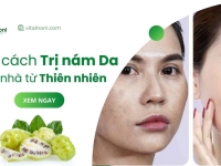 #11 Cách trị Nám tại nhà từ Thiên nhiên Hiệu Quả nhất