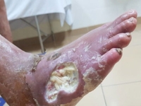 Công dụng nước cốt nhàu với tiểu đường