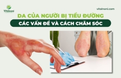 Da Của Người Bị Tiểu Đường: Các Vấn Đề Và Cách Chăm Sóc