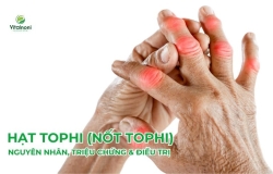 Hạt Tophi (Nốt Tophi): Nguyên Nhân, Triệu Chứng & Điều Trị