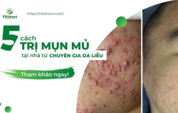 Mách bạn 5 cách Trị Mụn Mủ tại nhà từ Chuyên gia Da Liễu