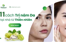#11 Cách trị Nám tại nhà từ Thiên nhiên Hiệu Quả nhất