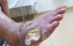 Công dụng nước cốt nhàu với tiểu đường