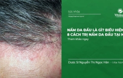 Nấm da đầu là gì? Biểu hiện và #8 Cách Điều Trị nấm da đầu tại nhà