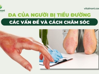 Da Của Người Bị Tiểu Đường: Các Vấn Đề Và Cách Chăm Sóc