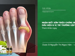Nhận biết sớm Triệu Chứng Bệnh Gout: Dấu hiệu & Vị trí thường gặp