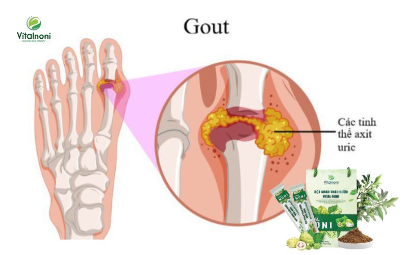 Nguyên nhân của bệnh Gout