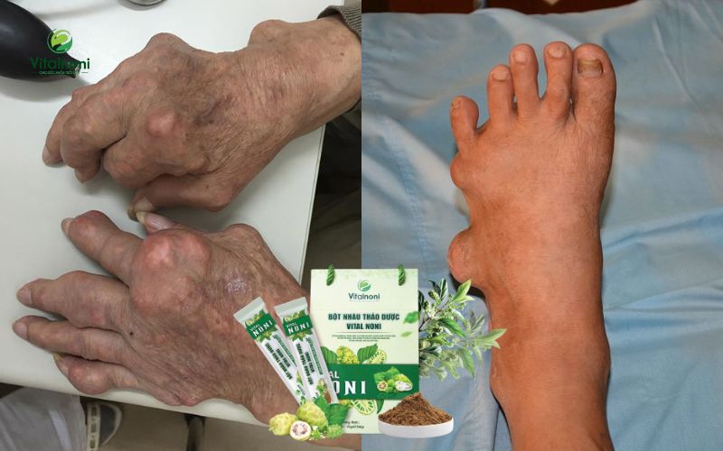 Tác dụng của bột trái nhàu trong hỗ trợ điều trị gout