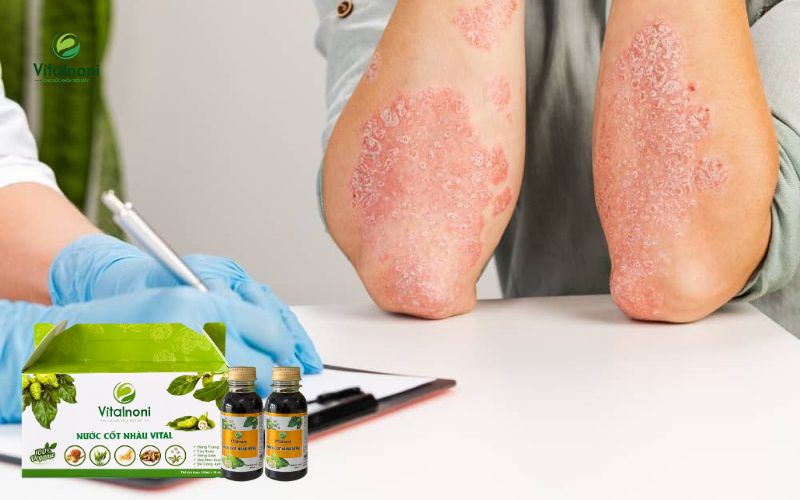 Tình trạng da khô, nứt nẻ và ngứa dai dẳng của người bị tiểu đường