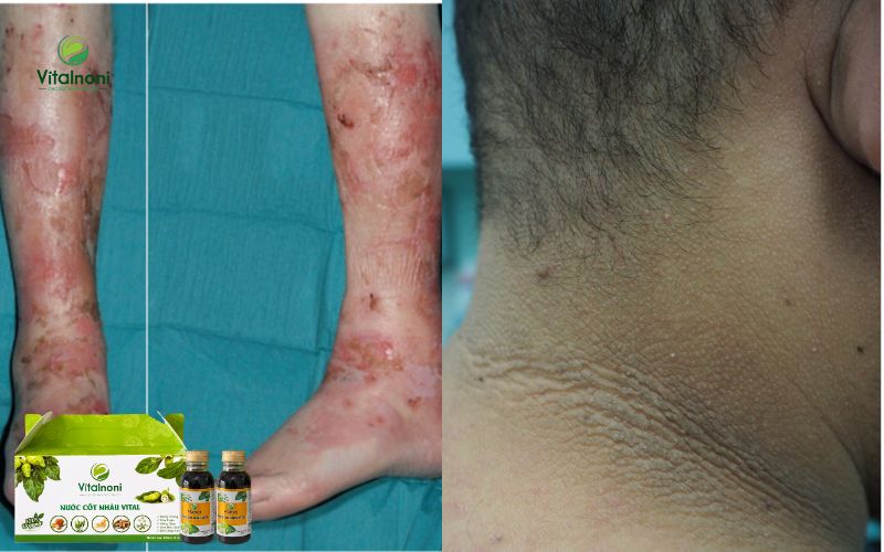 Bệnh da do tiểu đường và chứng Gai Đen