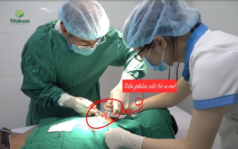 Tiểu phẫu cắt bỏ u mỡ