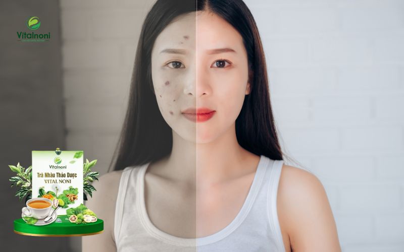 Lưu ý khi dùng trà mát gan trị mụn