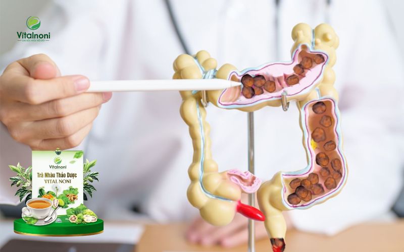 Lối sống ảnh hưởng nhiều đến tình trạng táo bón